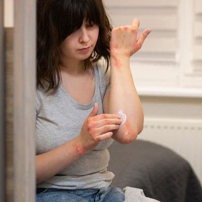 Dermatite herpétiforme : l'allergie au gluten qui se manifeste sur la peau