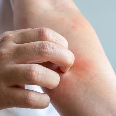 Dermatite atopique : comment rééquilibrer la flore cutanée pour apaiser les poussées