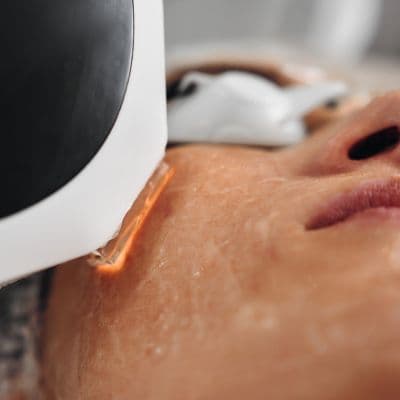 Laser CO2 fractionné : régénérer la peau en profondeur sans l'agresser