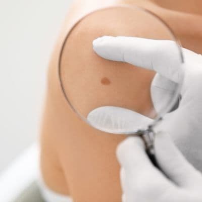 Mélanome amélanotique : le plus difficile à détecter à temps | Blog DocMorris