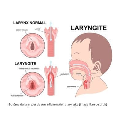 Laryngite chez l'enfant : comment la reconnaître et la soigner