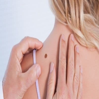 Dermatofibrome : tout savoir sur cette petite boule dure qui apparaît après une piqûre